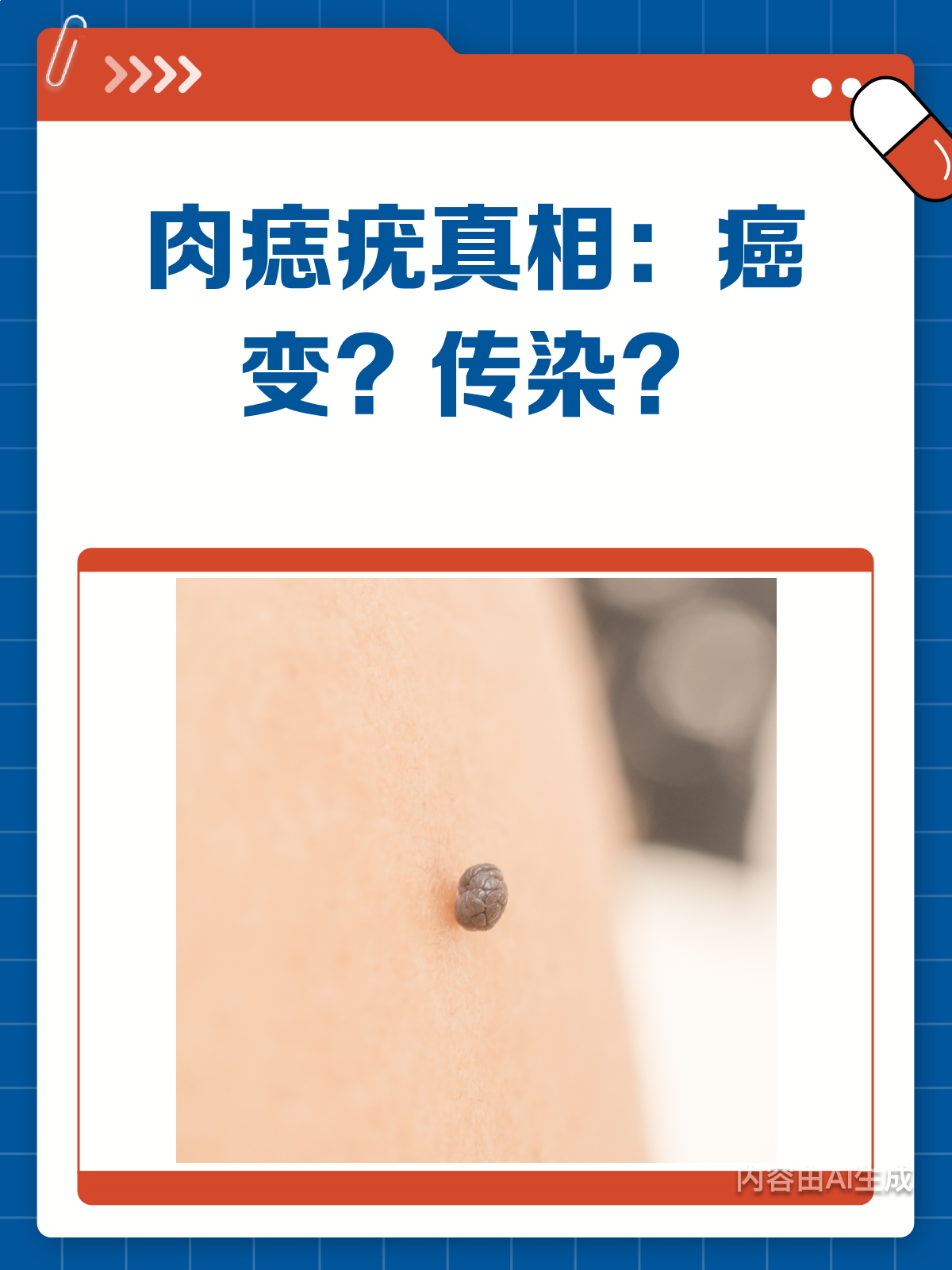 肉痣会癌变?疣会传染?一文说清楚!