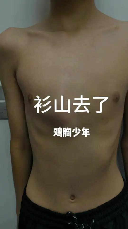 医疗创作者培优计划 鸡胸微创手术儿童胸外科岳芳主任“鸡胸”一词描述的是胸部向前异常凸起的现