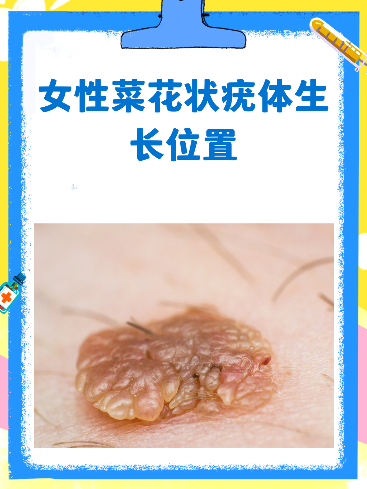 女性菜花状疣，这些私密部位要警惕！