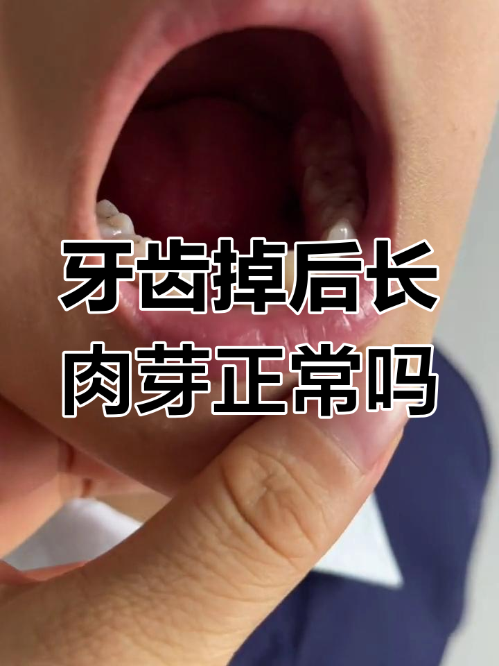 乳牙掉落后的肉芽是否正常?有点吓人