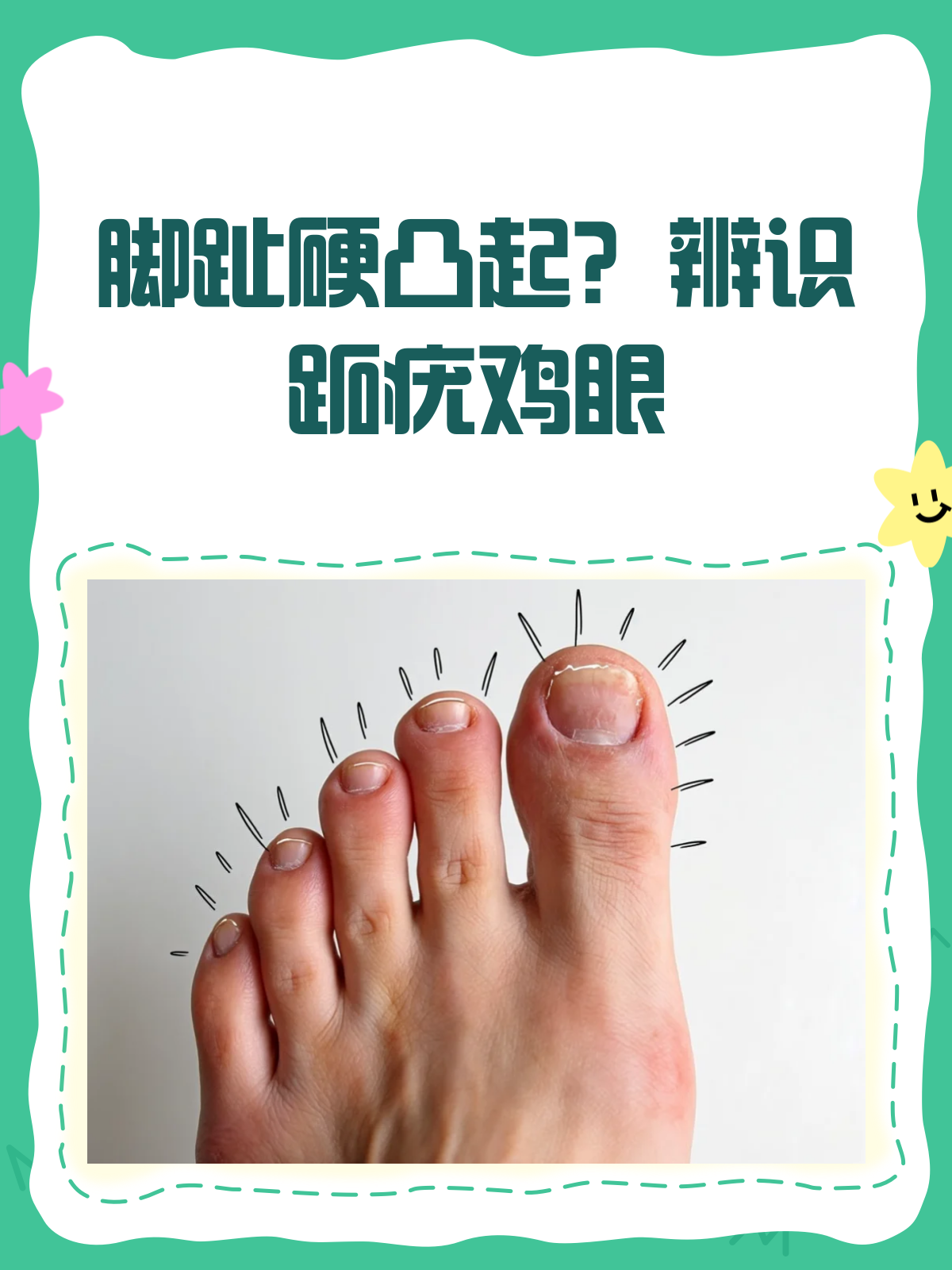 脚趾头硬凸起?揭秘跖疣、鸡眼还是啥?