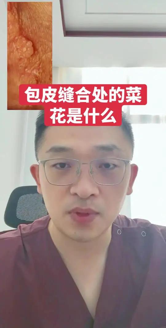 男性包皮缝合处的菜花是什么  