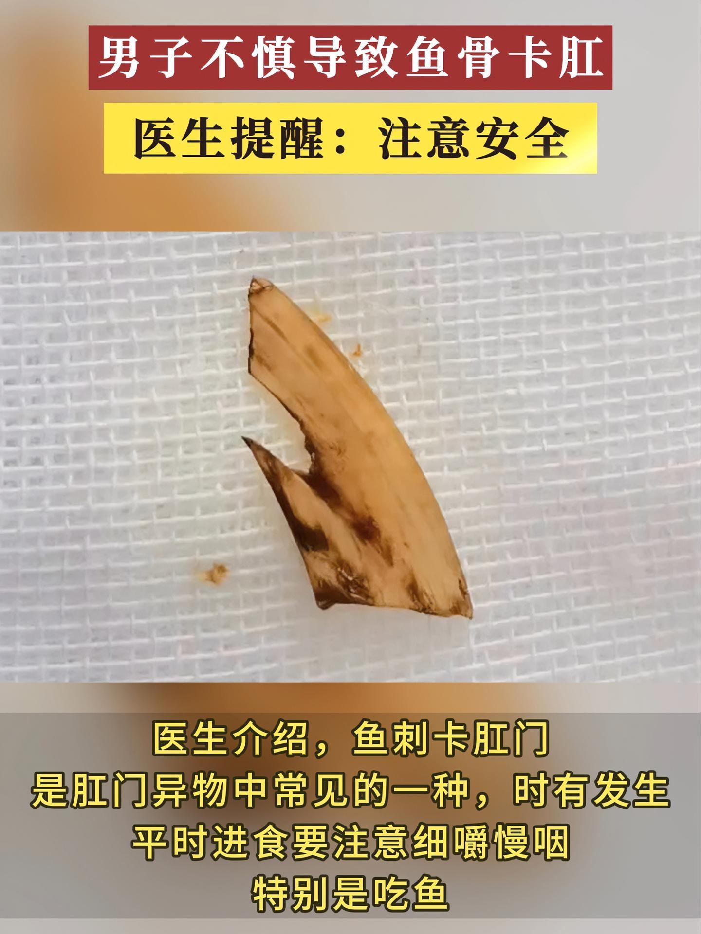男子不慎导致鱼骨卡肛,医生提醒:注意安全