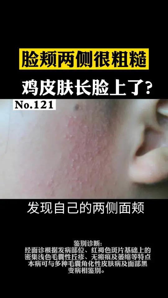 脸上长鸡皮肤?其实这可能是面部毛囊
