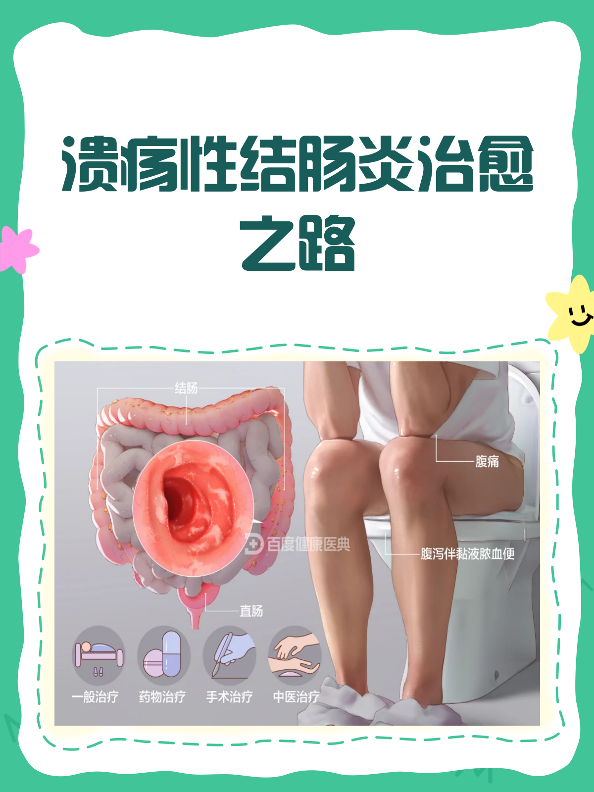 溃疡性结肠炎,治愈之路怎么走?
