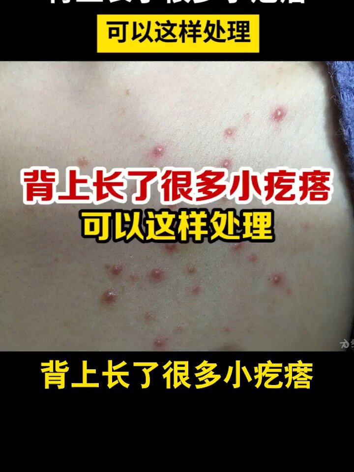 背上长很多的的小疙瘩,可以这样处理