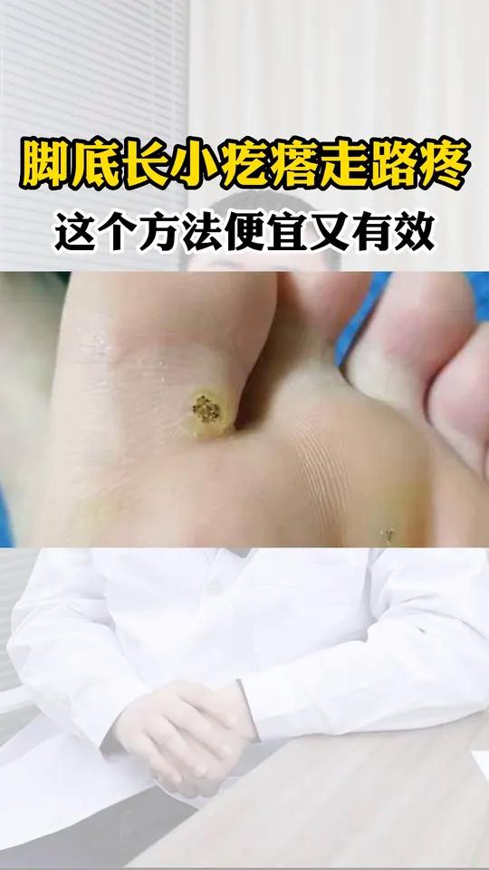 脚底长这种灰黄色的疙瘩,走路还疼,这可不是鸡眼,不及时处理还会越长越多,教你简单处理