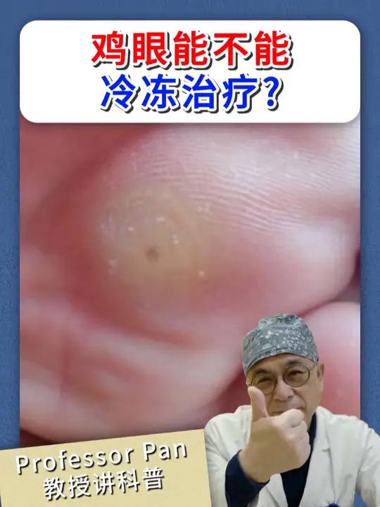 鸡眼能不能冷冻治疗 鸡眼 冷冻治疗