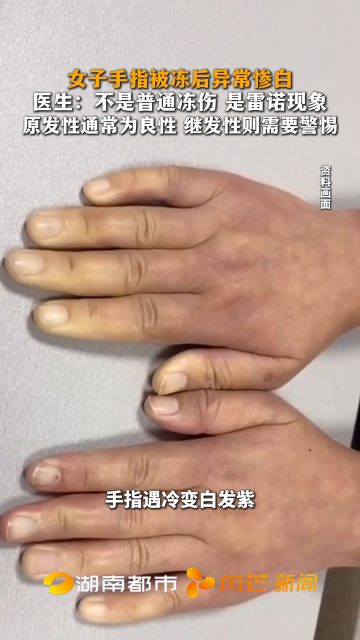 女子手指被冻后异常惨白 医生:不是普通冻伤