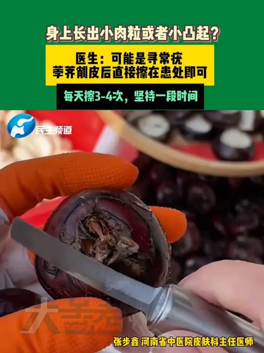 身上长出小肉粒或小凸起?医生:可能是寻常疣,荸荠削皮后直接擦拭患处即可,每天3到4次