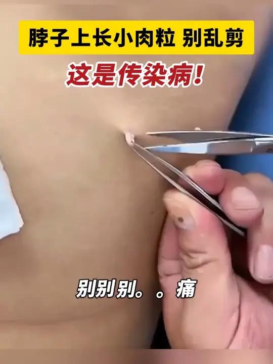 脖子上长这种粗糙的小肉粒是丝状疣，千万别自己用剪刀剪，小心越长越多！