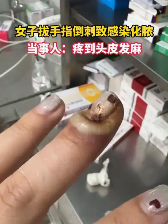 女子拔手指倒刺致感染化脓,当事人:疼到头皮发麻