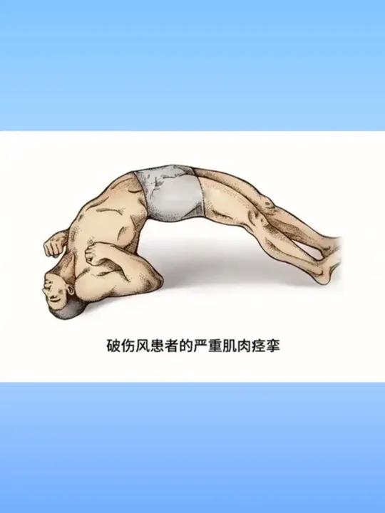 破伤风毒素导致背部肌肉痉挛