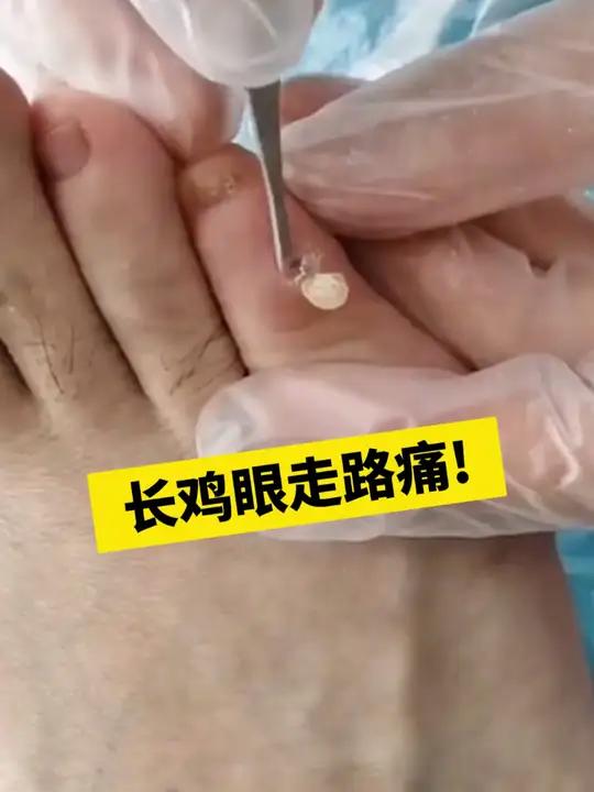 长了鸡眼别担心,也别硬挖,教你简单一招处理!
