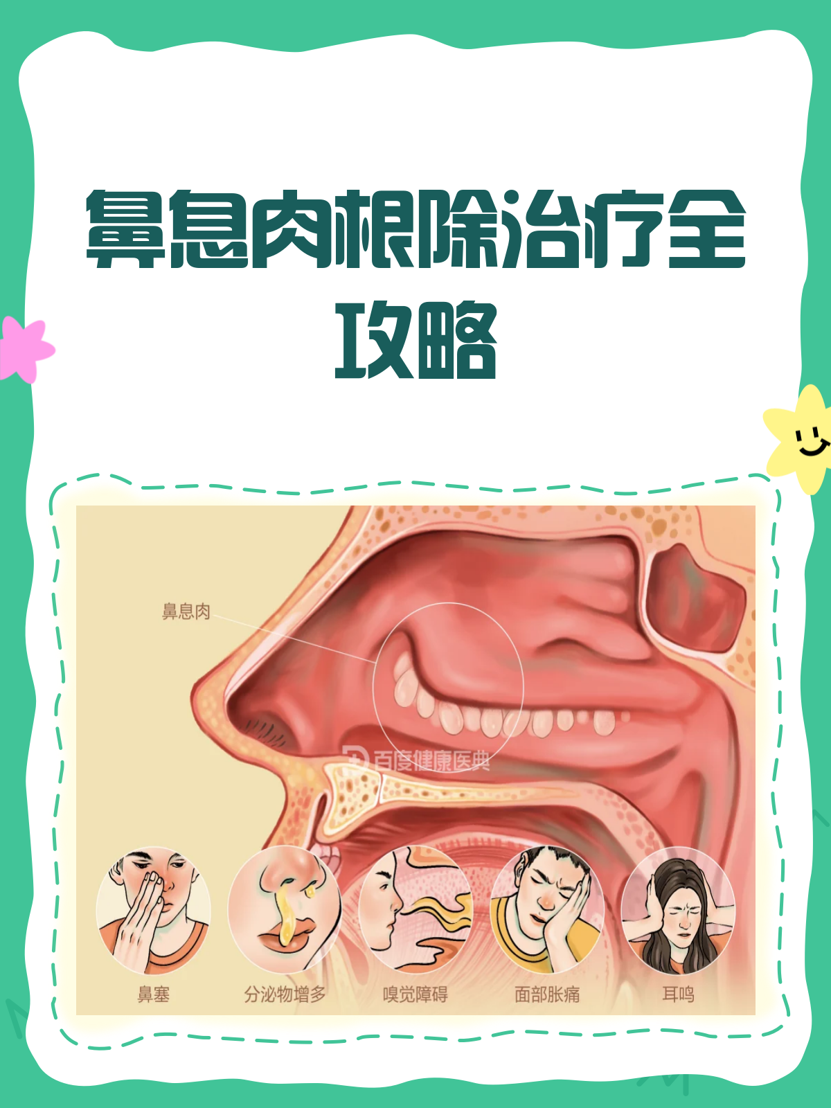 鼻息肉治疗全攻略,根除有法可循!