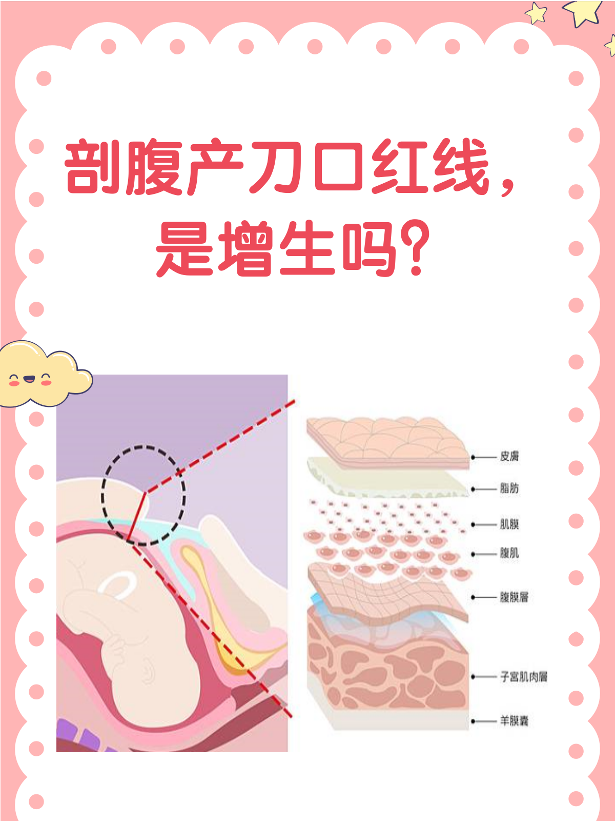 剖腹产刀口红色一条线,是增生了吗