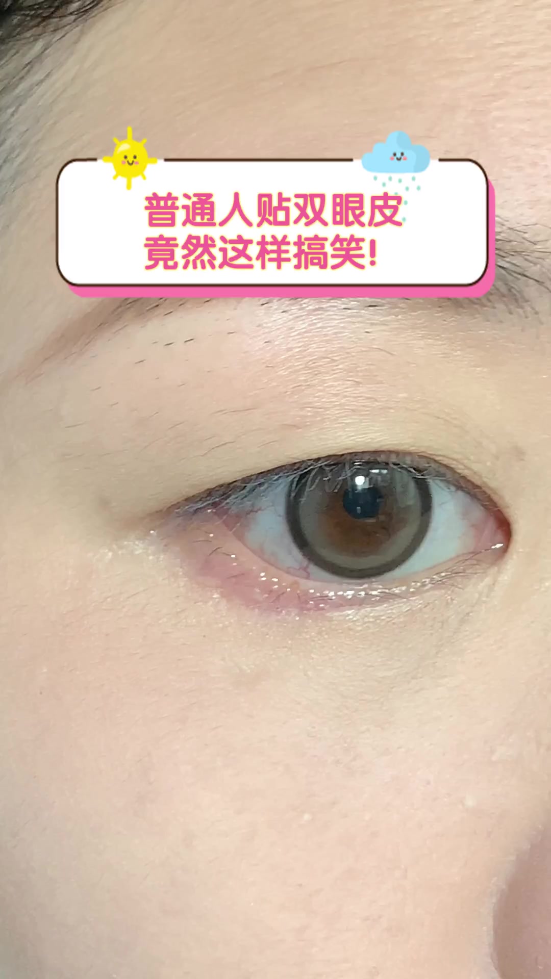 普通人贴双眼皮,竟然这样搞笑!