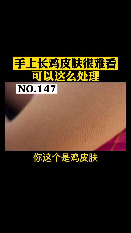 手上长鸡皮肤很难看,短袖都不敢穿,可以试试这么处理