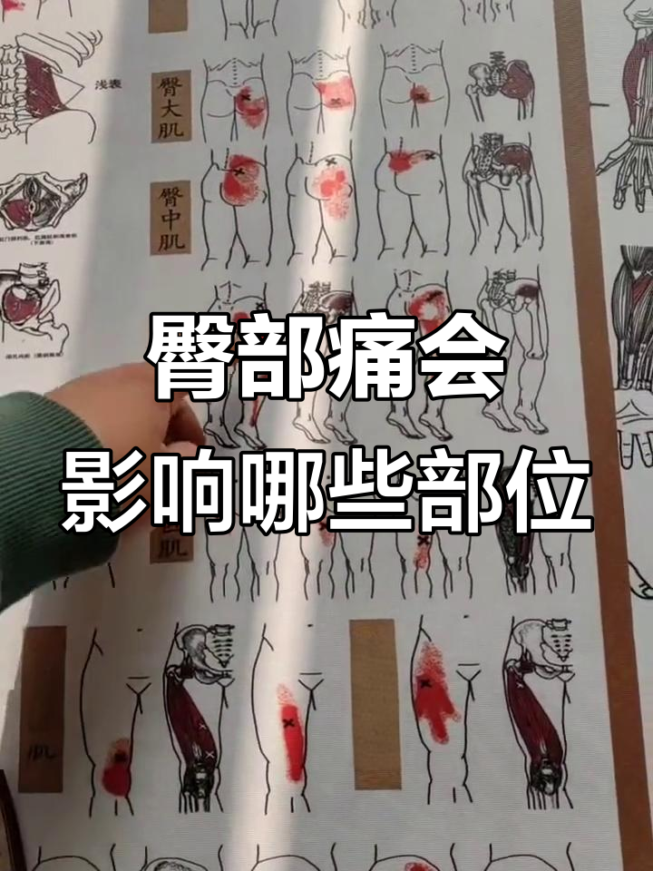 臀小肌疼痛如何影响大腿和小腿?按摩能缓解吗