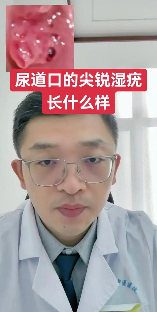 尿道口的尖锐湿疣长什么样