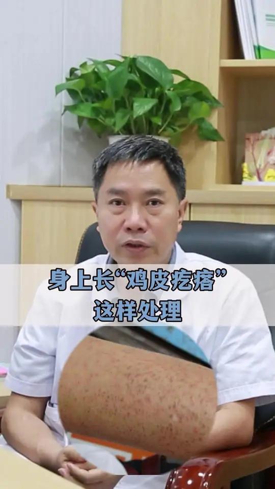 手臂、大腿长“鸡皮疙瘩”总是让人烦恼,这个视频李主任教你怎么处理这烦人的“鸡皮疙瘩”鸡皮疙