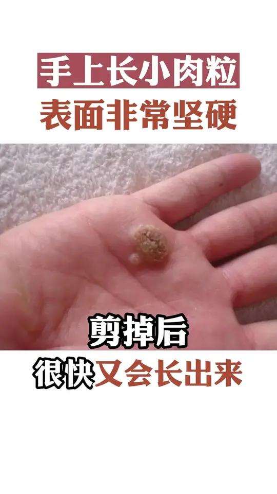 手上长了小肉粒,剪掉之后还会长,这是寻常疣应该这样处理