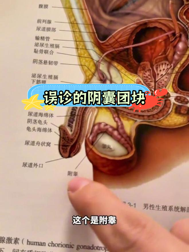 阴囊内条索状结构,竟是附睾而非精索静脉曲张