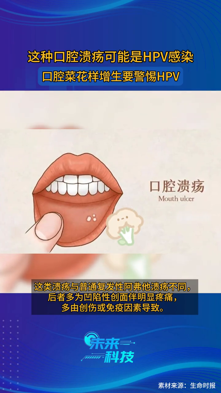 这种口腔溃疡可能是HPV感染!口腔菜花样增生要警惕HPV