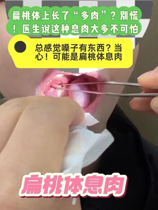 总感觉嗓子有东西？当心！可能是扁桃体息肉 总感觉嗓子有东西？当心！可能是扁桃体息肉 扁桃体
