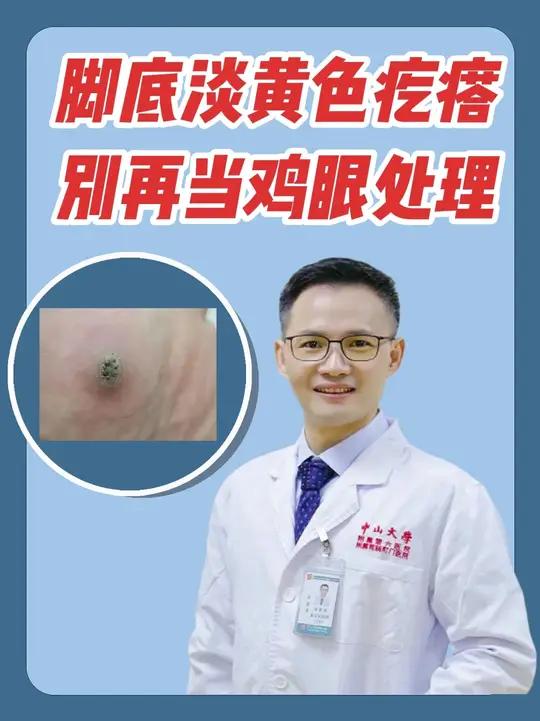 脚底淡黄色疙瘩，别再当鸡眼处理医学科普医疗健康创作训练营鸡眼跖疣傻傻分不清