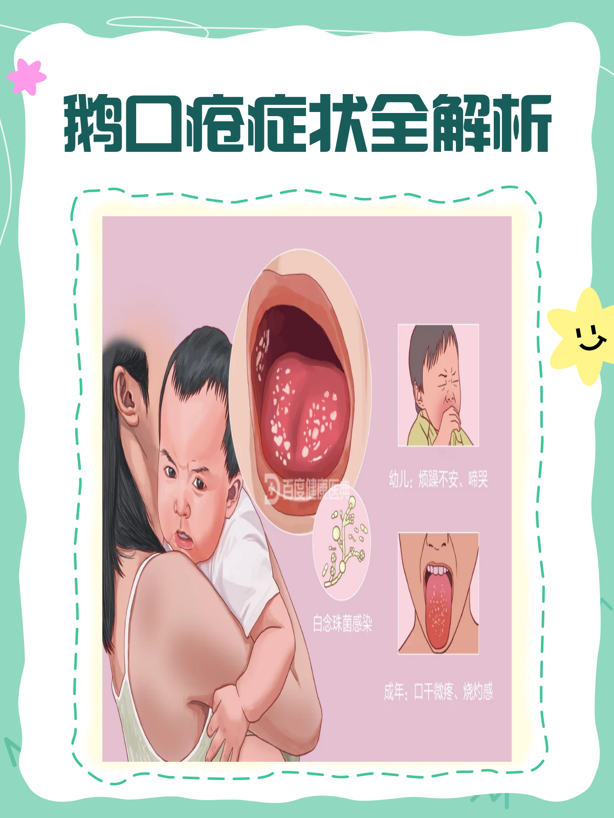 鹅口疮大揭秘!看看它到底长啥样?