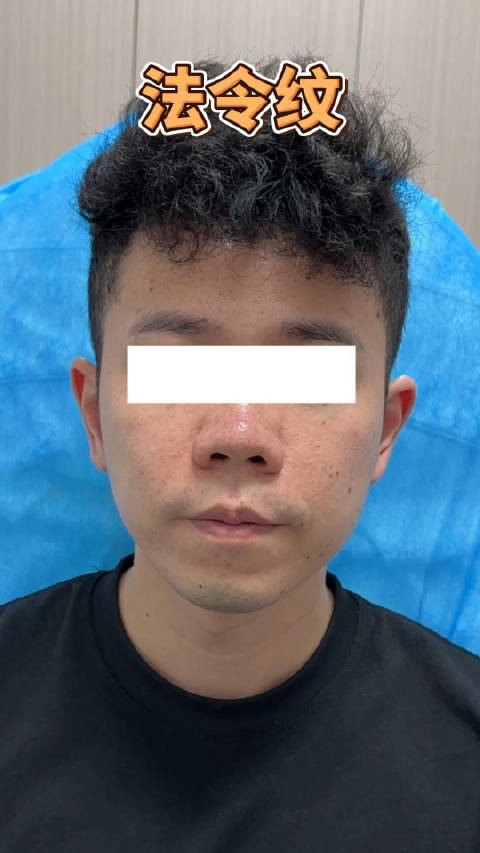 「法令纹填充」该求美者性格开朗爱笑,但法令纹呈八字形垂直向下,不做表情也显眼,动态微笑褶子