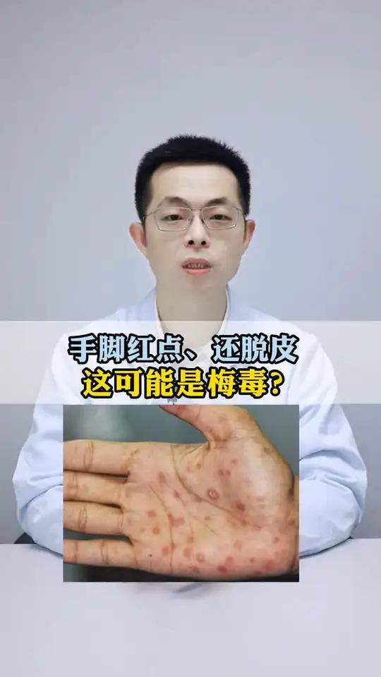 手掌、脚掌长红色小点,还脱皮,这可能是梅毒!