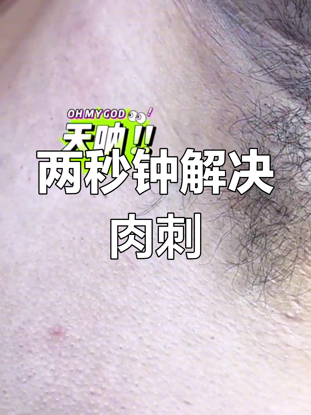 轻松去除困扰十年的肉刺