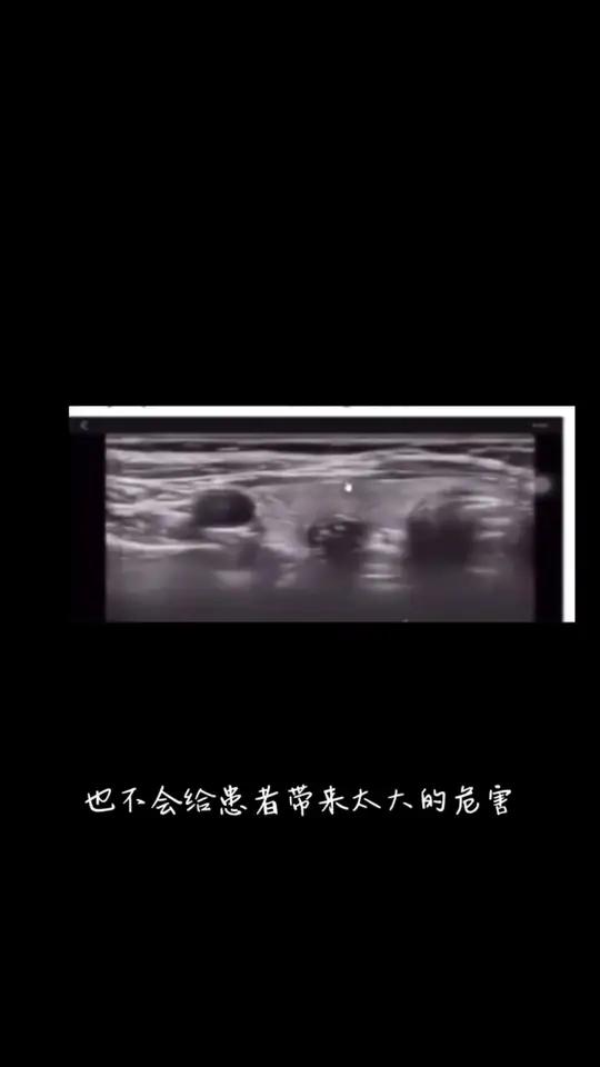 聊一聊甲状腺“僵尸结节”!