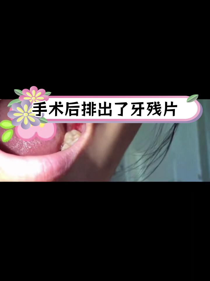 拔智齿后长肉,竟是牙残片排出