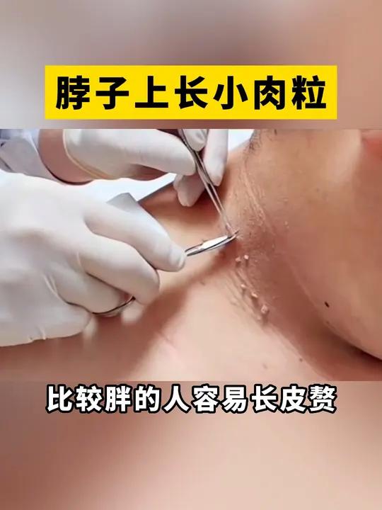 脖子上长这种小肉粒,这是皮赘,别自己剪,小心感染