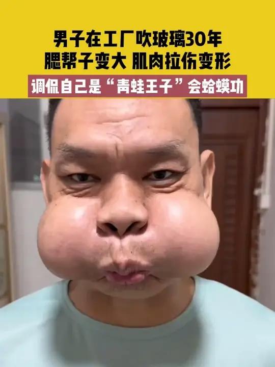 12月16日(发布)广东,男子在工厂吹玻璃30年,腮帮子变大 肌肉拉伤变形,调侃自己是“青