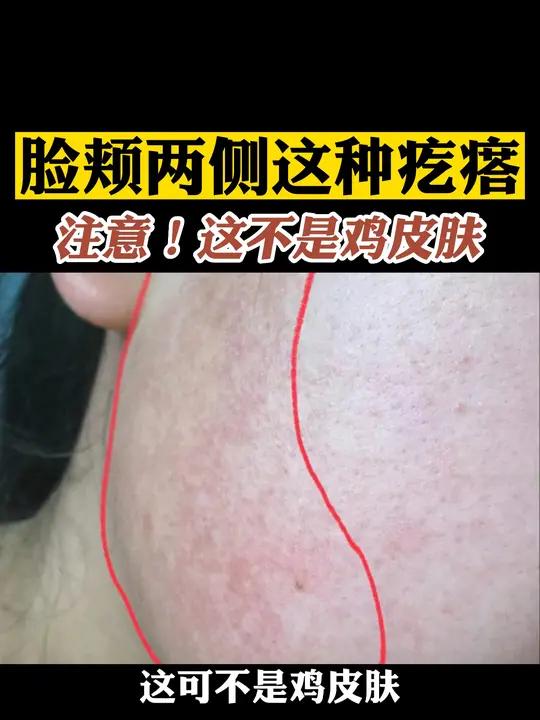脸上的这种小疙瘩不是鸡皮肤,它是毛囊红斑黑变病,小孩一般容易长!