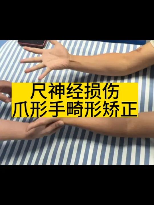 尺神经损伤爪形手畸形怎么办?尺神经损伤爪形手爪形手矫正手功能康复 神经损伤张有来博士