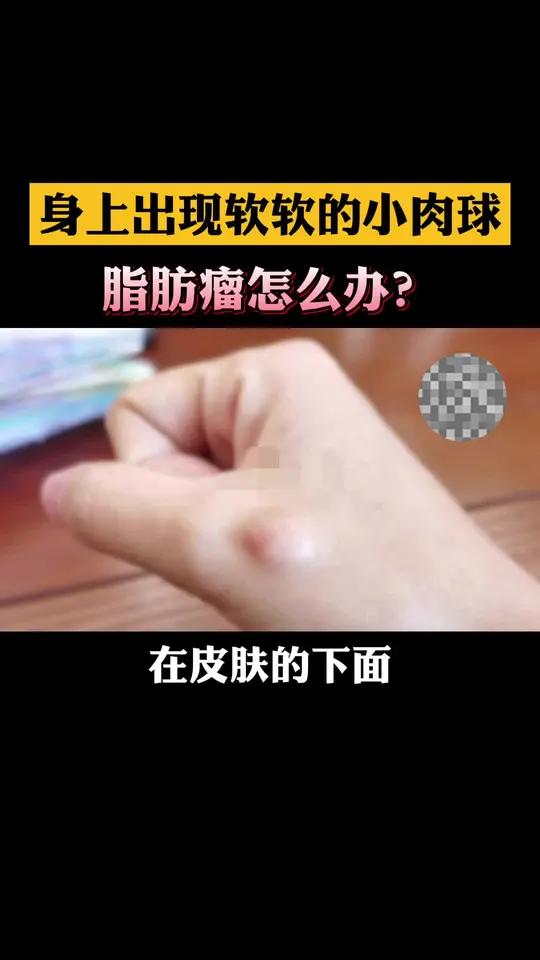 身上出现软软的小肉球,轻推还会移动,脂肪瘤可以这么办