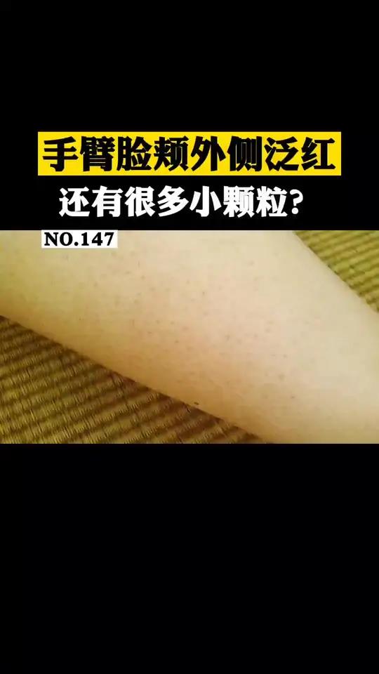脸颊两侧长鸡皮肤非常影响美观,不用太过于在意,还是有办法改善的!
