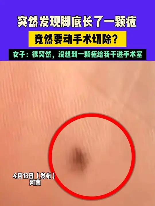 4月13日(发布)河南,突然发现脚底长了一颗痣,竟然要动手术切除?女子:很突然,没想到一颗