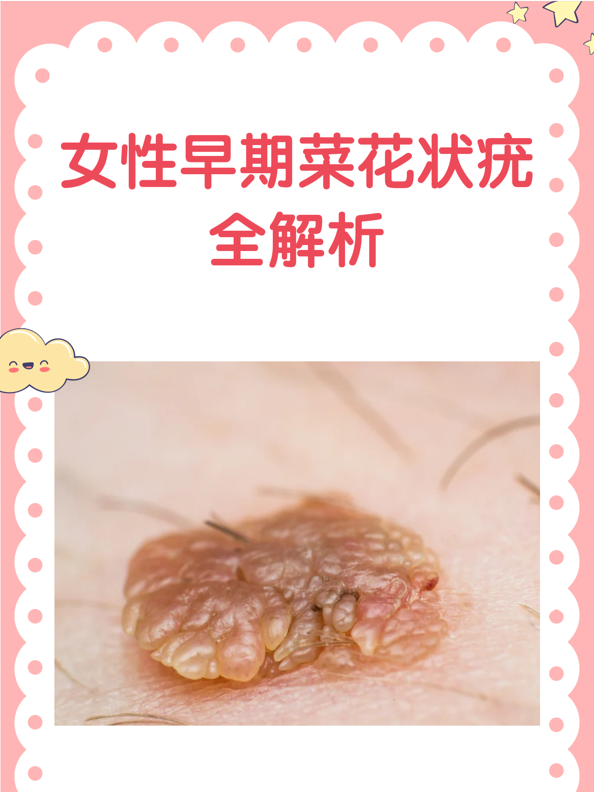 女性早期菜花状疣，你了解多少？