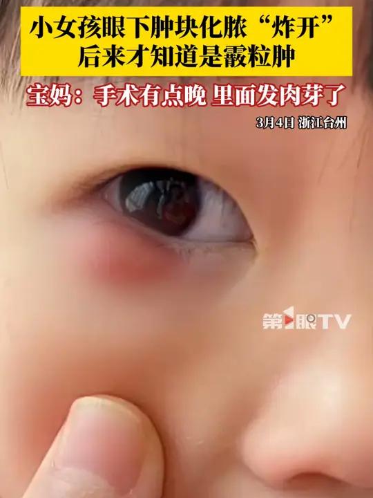小女孩眼下肿块化脓“炸开”,后来才知道是霰粒肿,宝妈开始带孩子去区里的医院割过一次,没清理