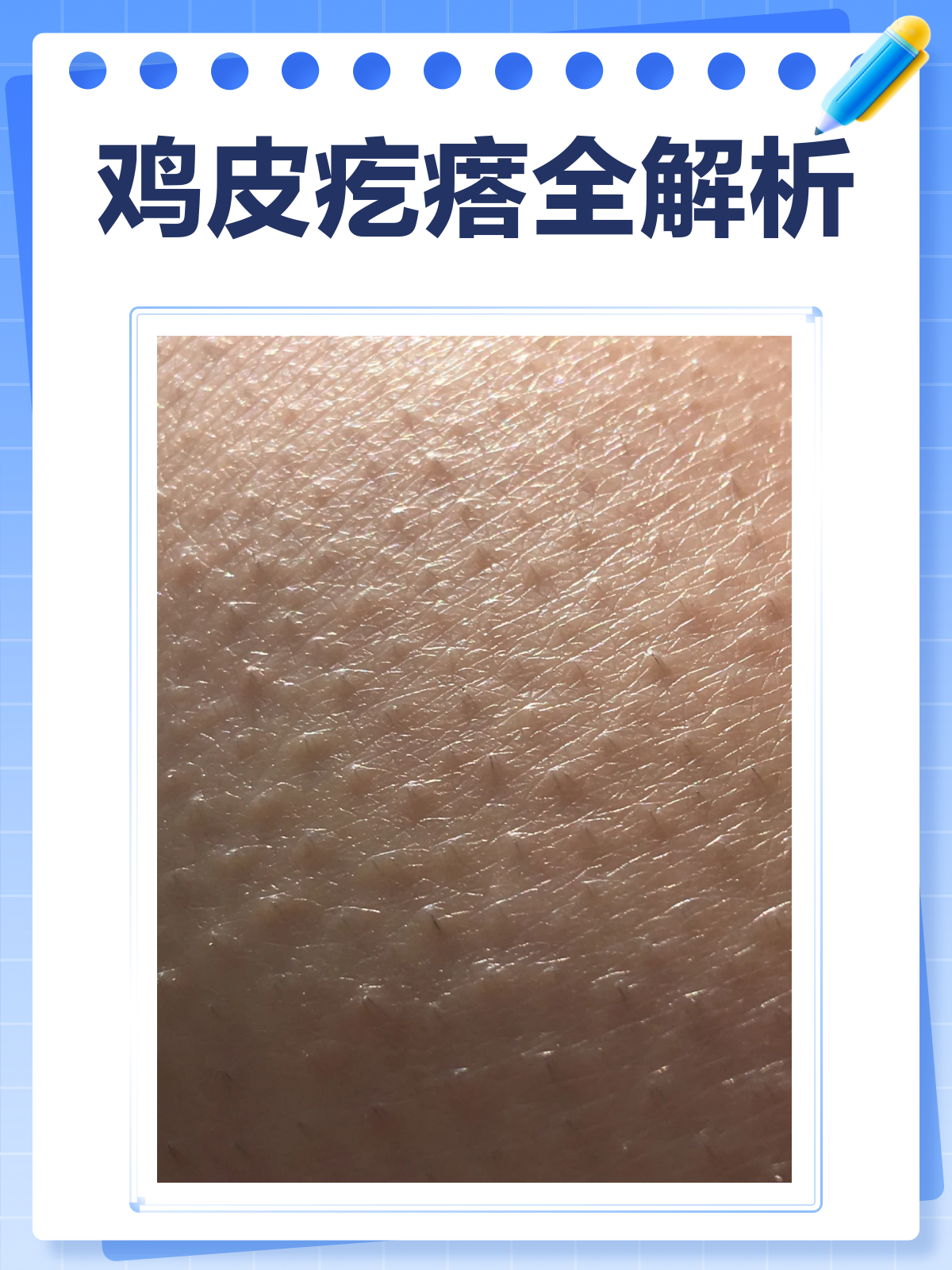 鸡皮疙瘩是咋回事？一文给你讲明白！