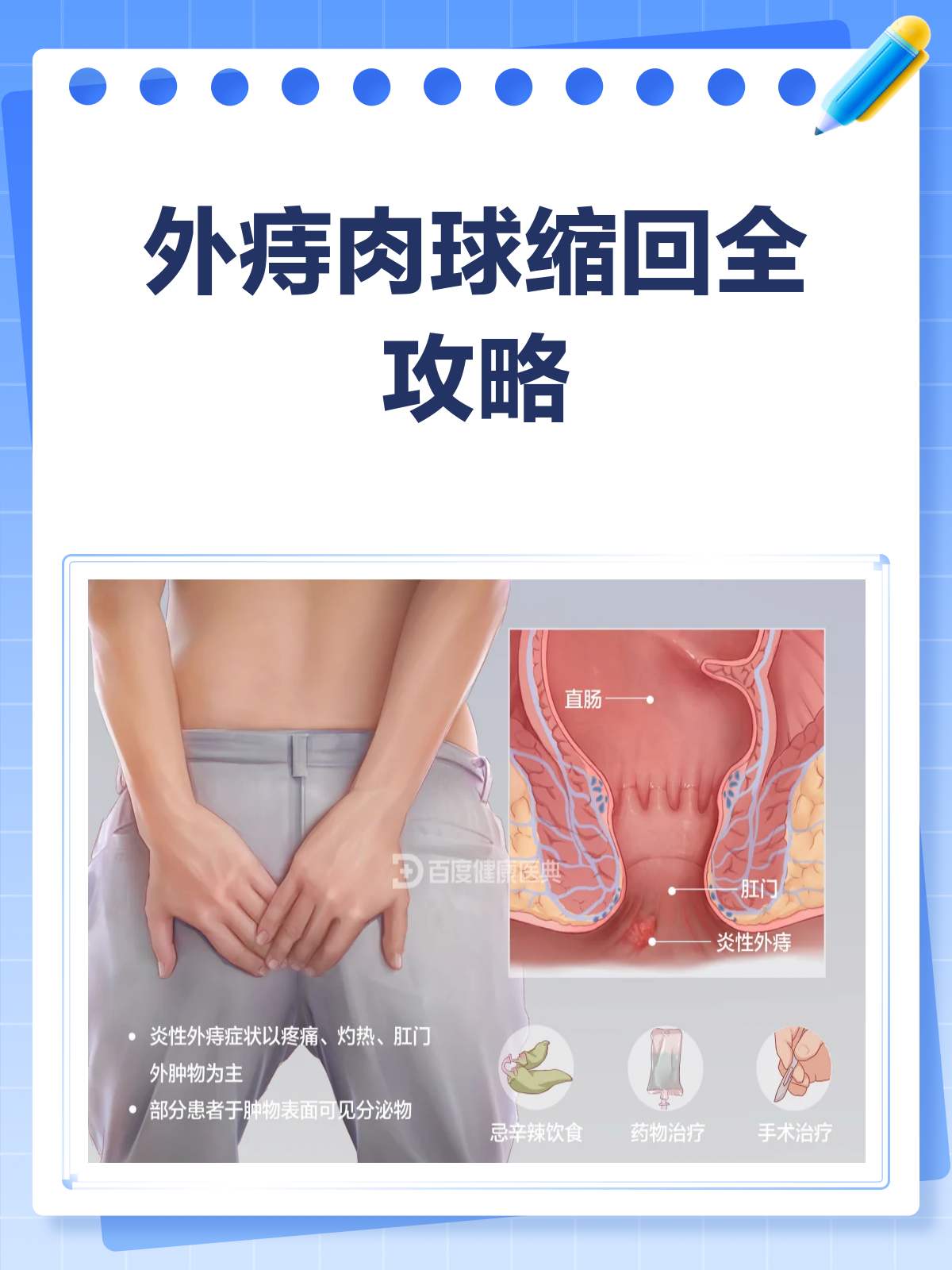 外痔肉球缩回攻略,轻松解决你的难言之隐!