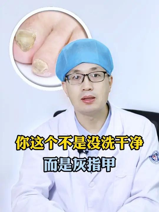 脚趾甲出现这些症状,就要小心灰指甲了!指甲发黄增厚,甲肉分离,这个视频一定要看完