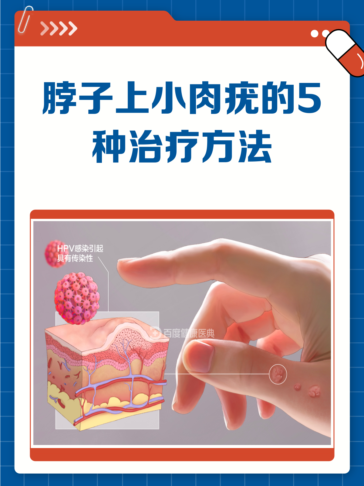 脖子上的小肉疣?别急,这样治疗就对了!