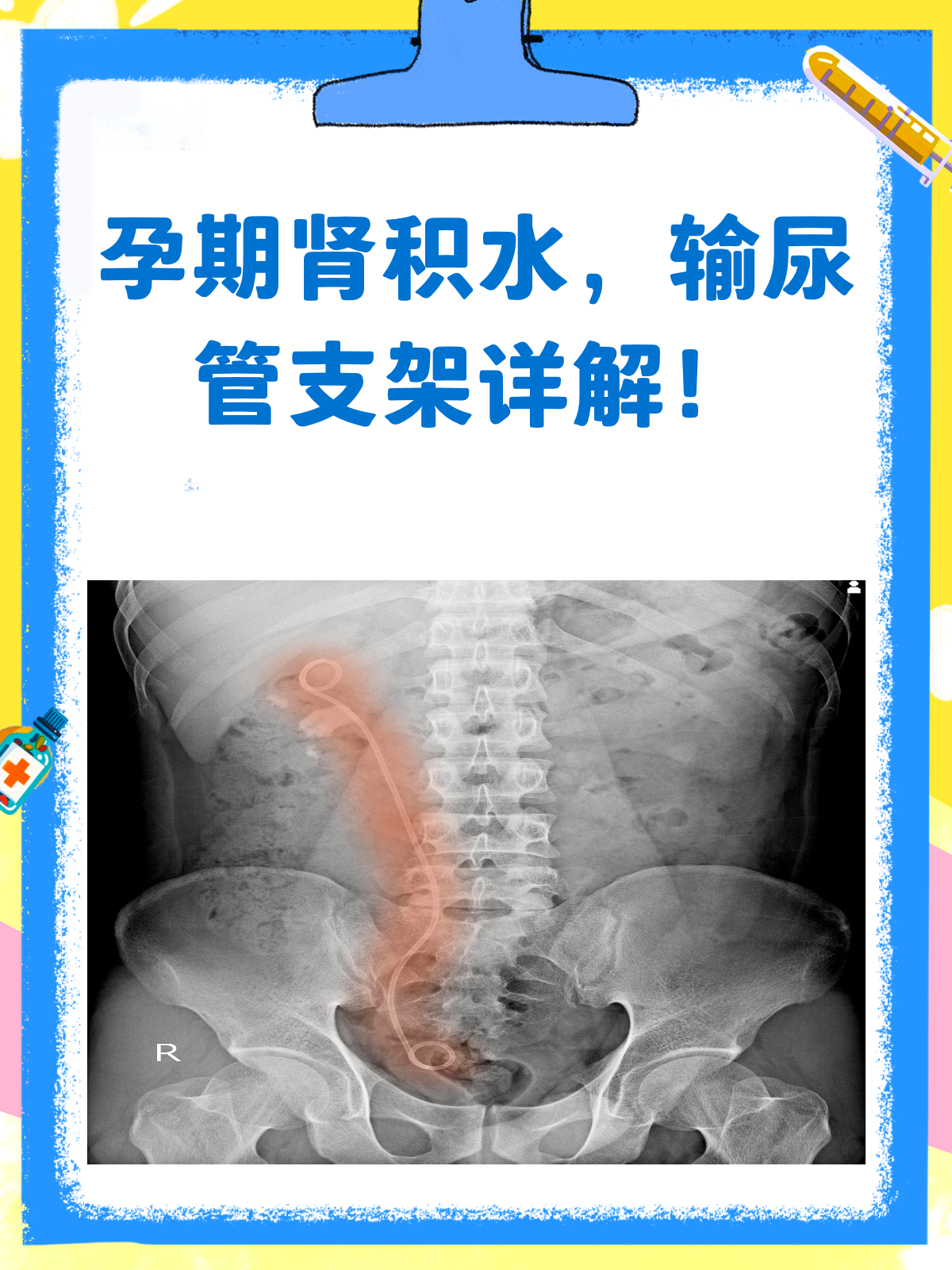 孕期肾积水怎么办?输尿管支架来帮忙!